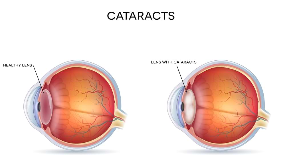 Cataract diagnosis in Hobart, Tasmania.