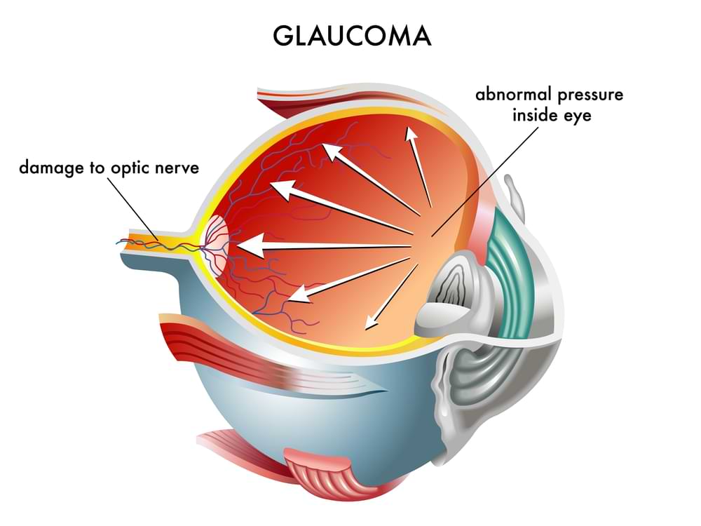 Glaucoma treatment in Hobart, Tasmania.