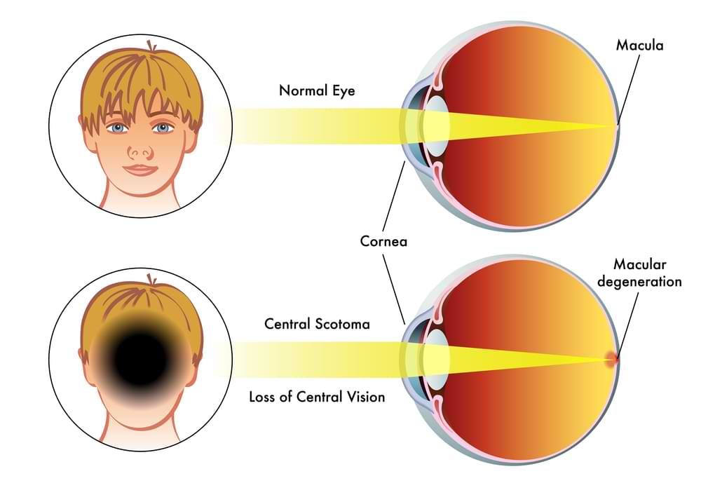 Macular degeneration diagnosis, Hobart, Tasmania.